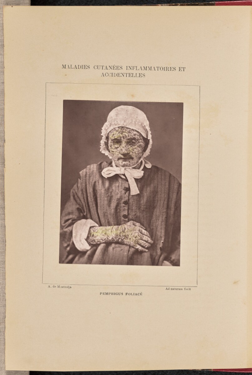 Pemphigus foliacé