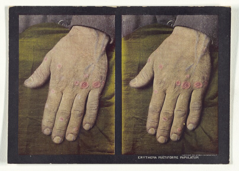 Erythema Multiforme Papulatum