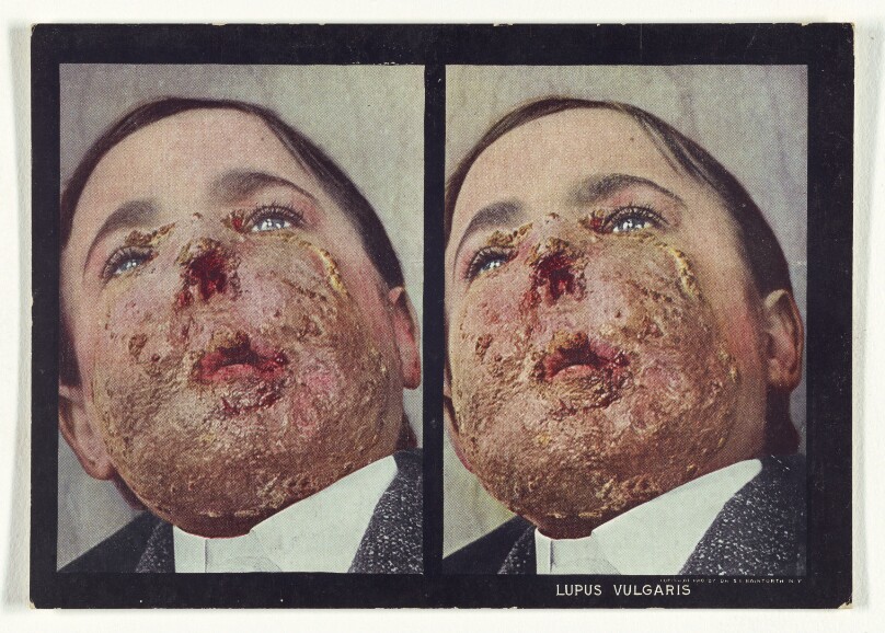 Lupus Vulgaris