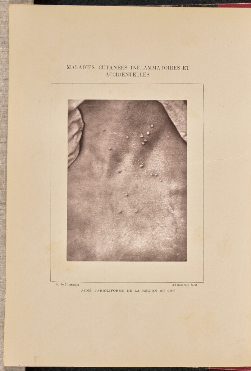 Acné varioliforme de la région du cou