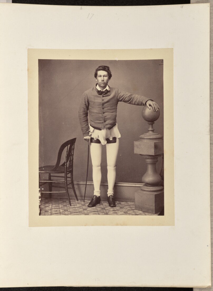 Amputation of both Thighs for Gunshot Injury
