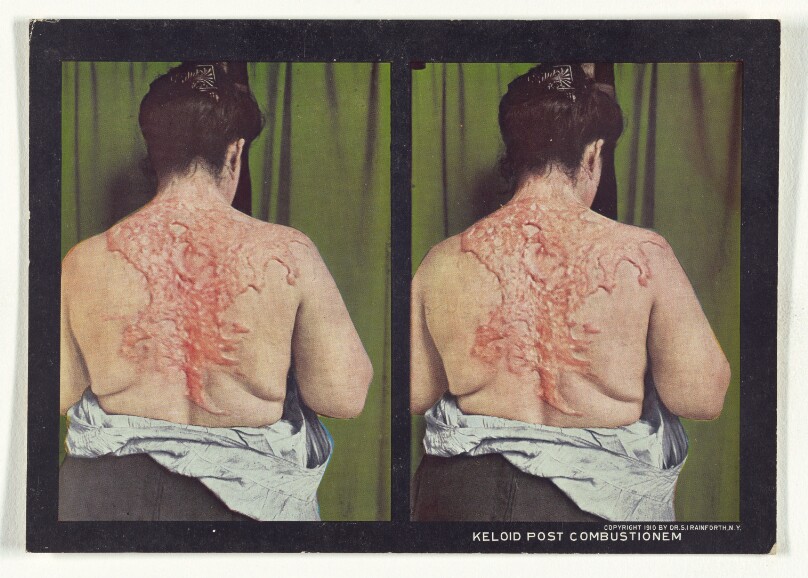 Keloid Post Combustionem