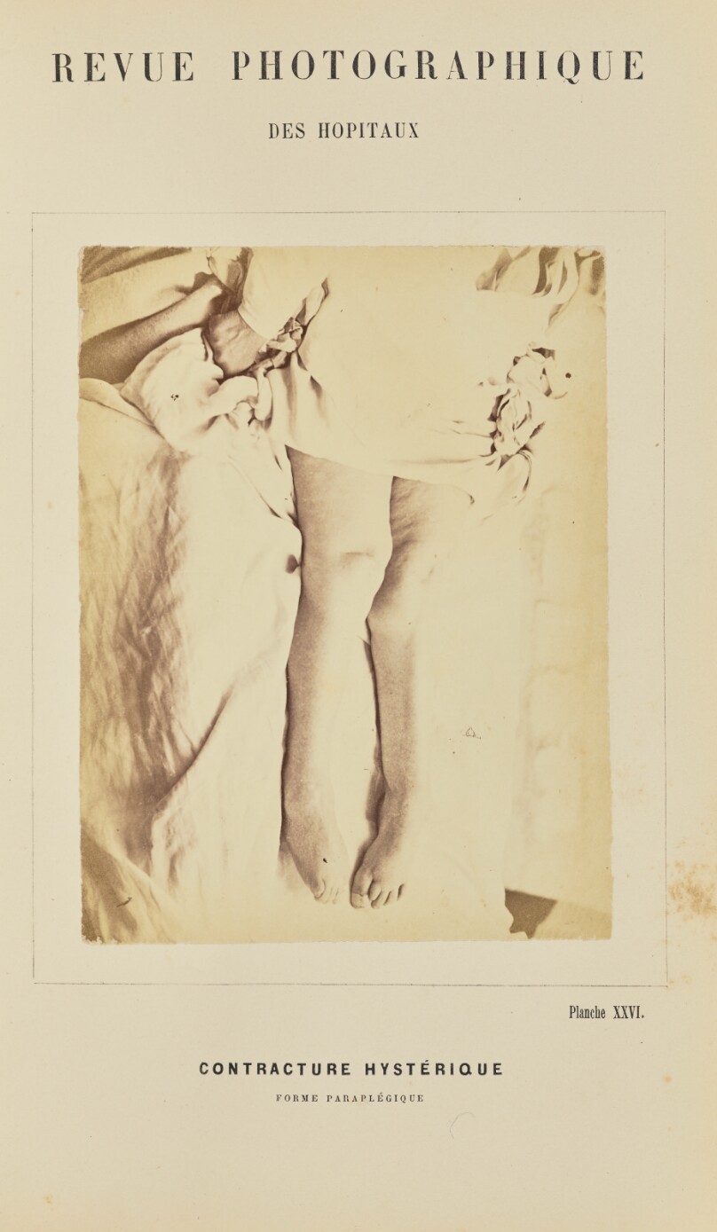 Contracture hystérique, form paraplégique