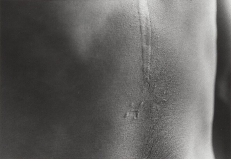 Scars #51 (Illness 1980)