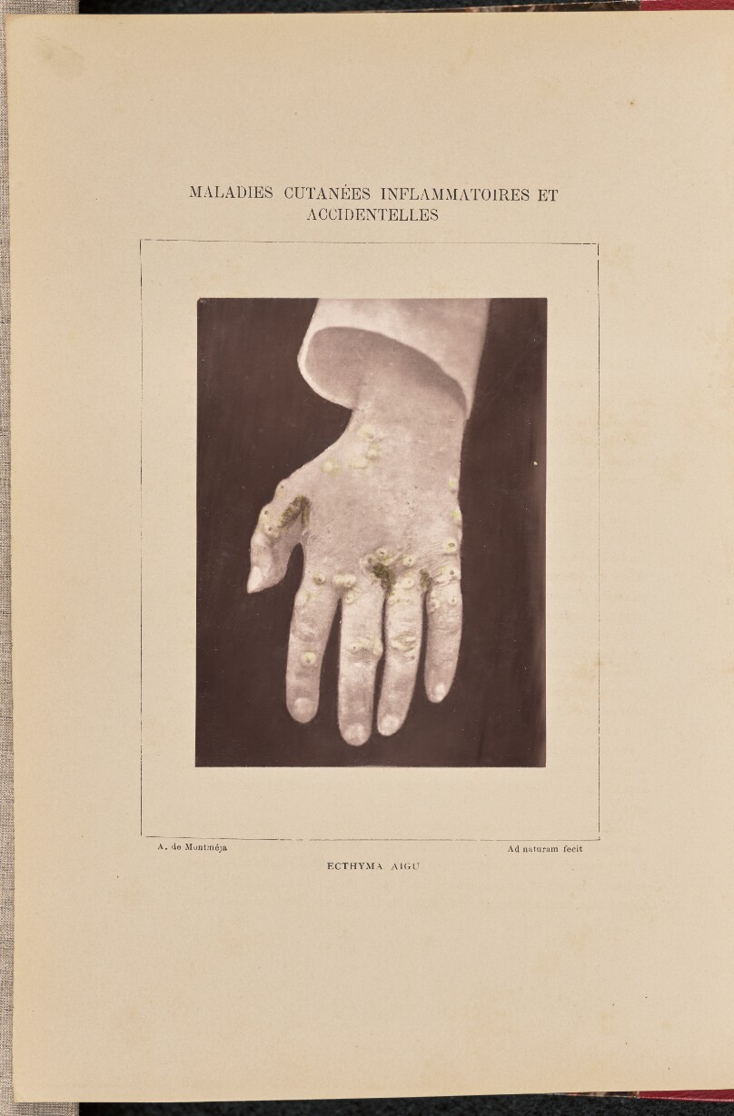 Ecthyma aigu