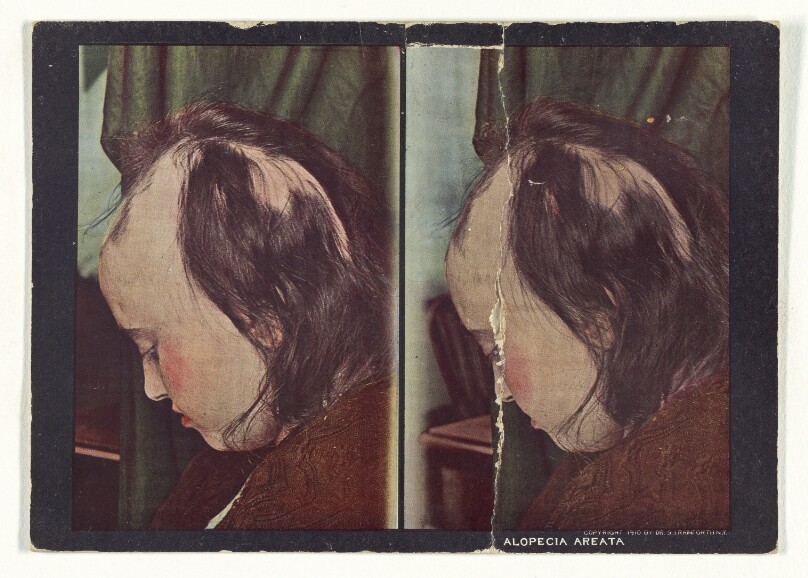 Alopecia Areata