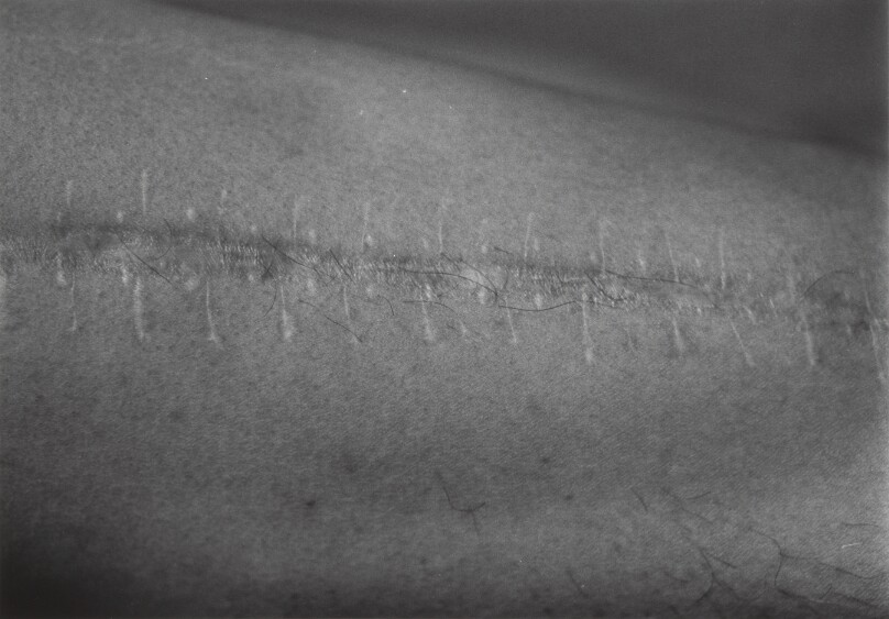 Scars #50 (Accident 1981)