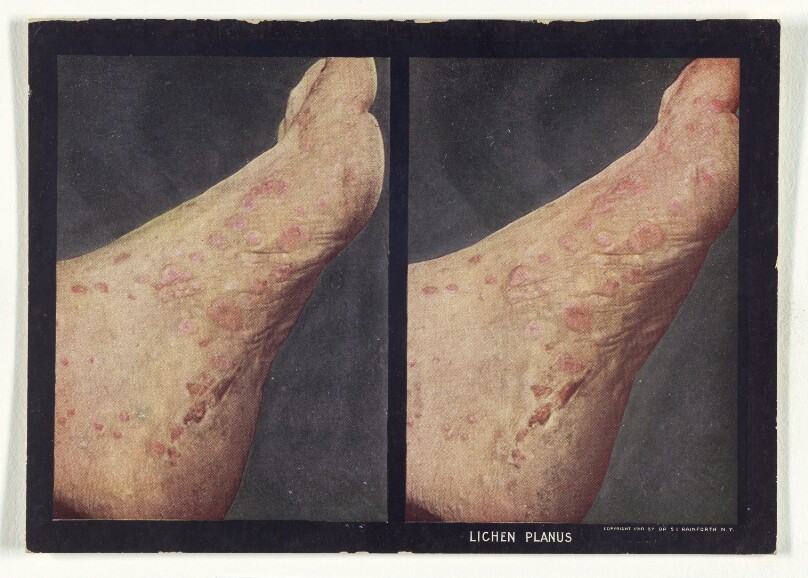 Lichen Planus