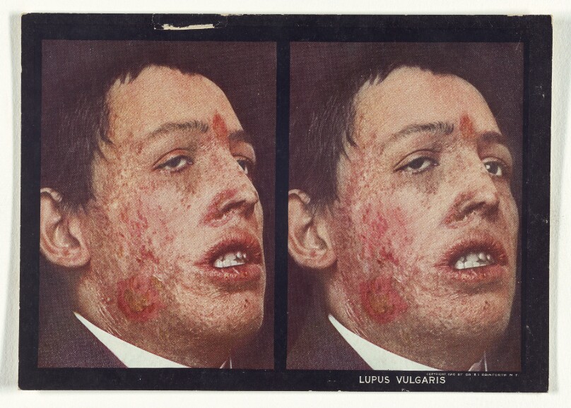 Lupus Vulgaris