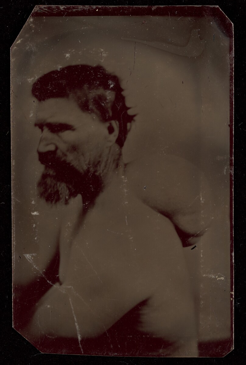 [Portrait of a Bearded Man with Abnormal Growth on Back]