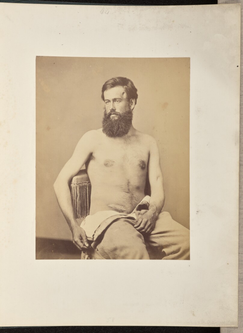 Case of Corporal Bemis, thrice secerely wounded in Three Battles
