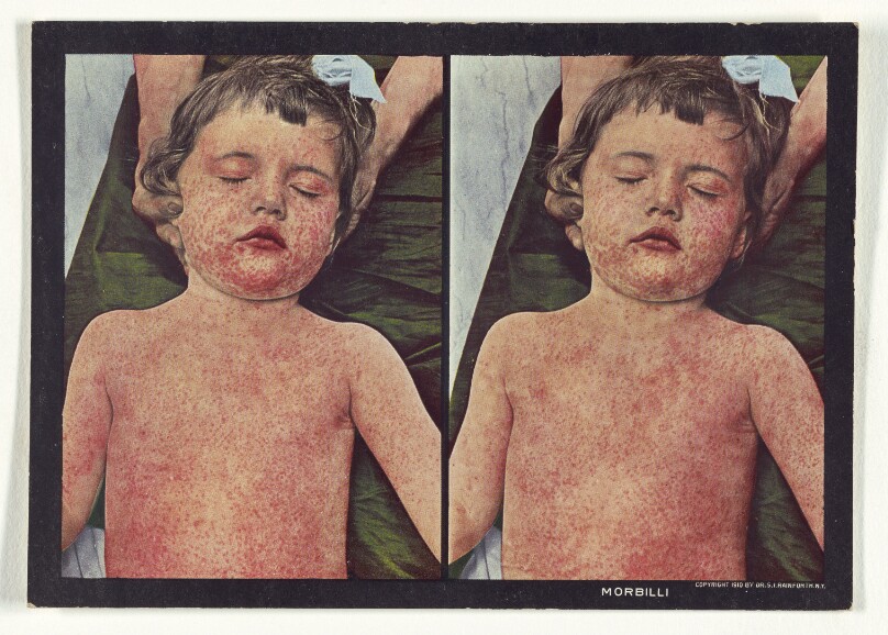 Morbilli