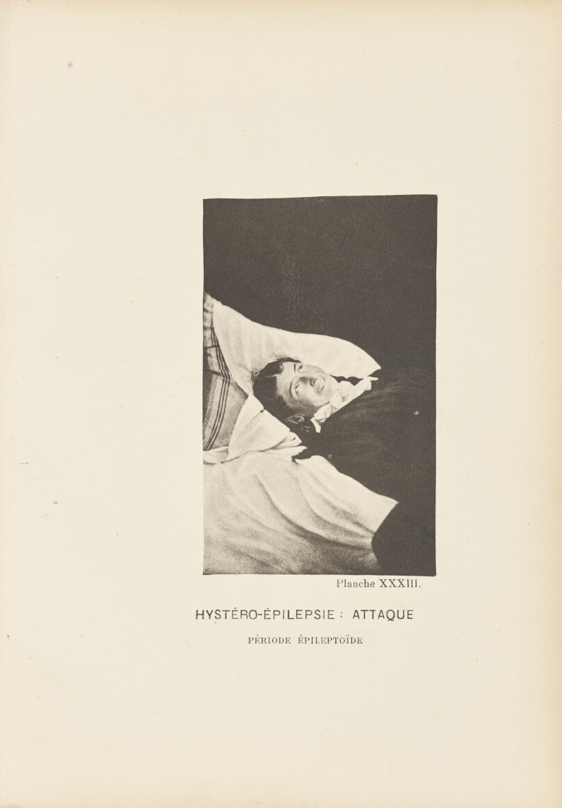 Hystero-Epilepsy: Epileptoid Attack Phase