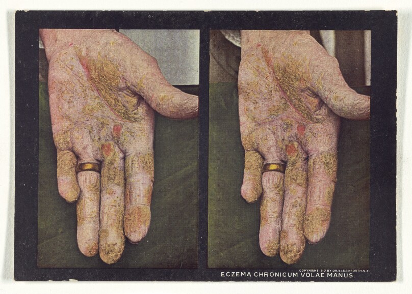 Eczema Chronicum Volae Manus