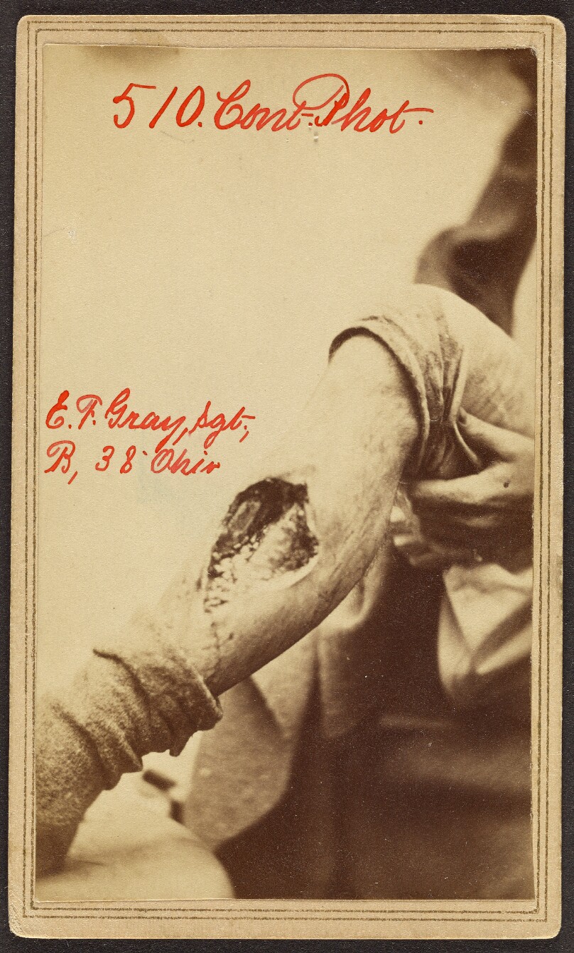 Edward F. Gray. Sergt. Co. B. 38# Ohio. [Civil War victim]