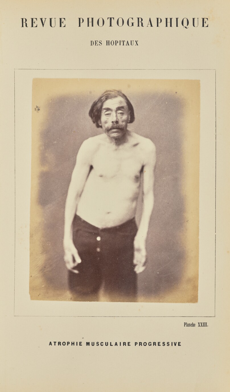Atrophie musculaire progressive