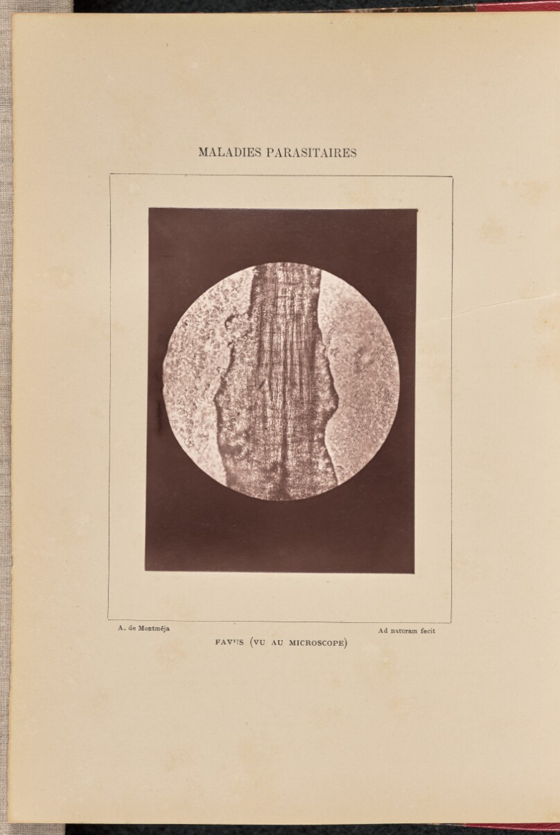 Favus (vu au microscope)