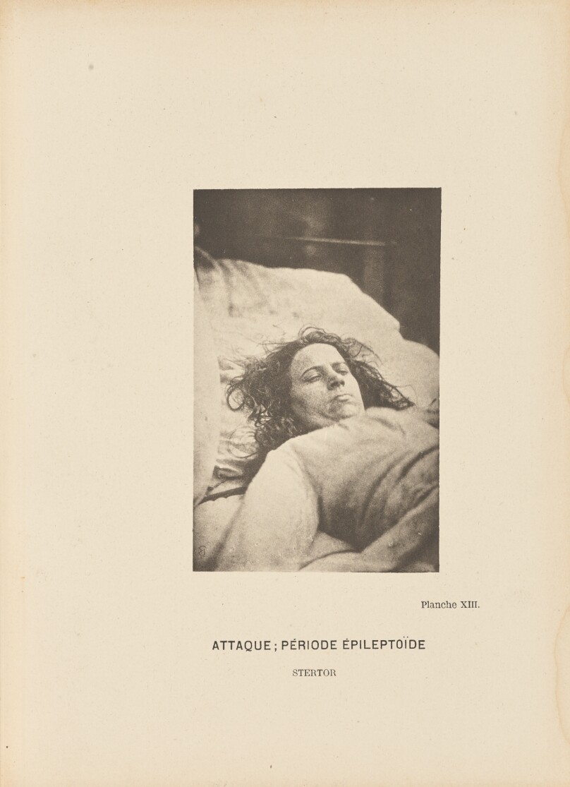 Attaque; Période Épileptoïde Stertor