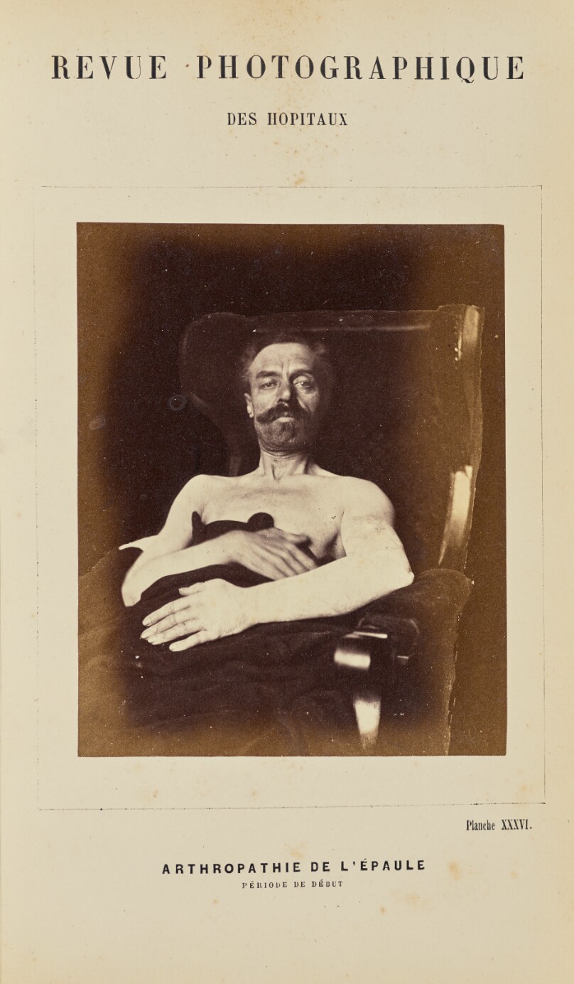 Arthropathie de l'épaule, période de début