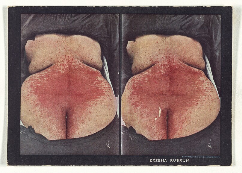 Eczema Rubrum