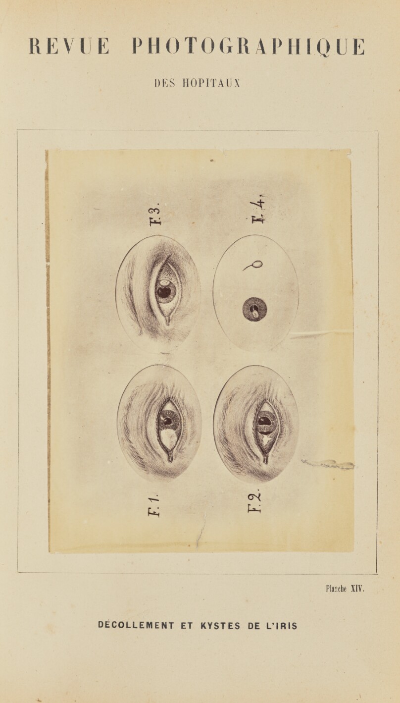 Décollement et kystes de l'iris