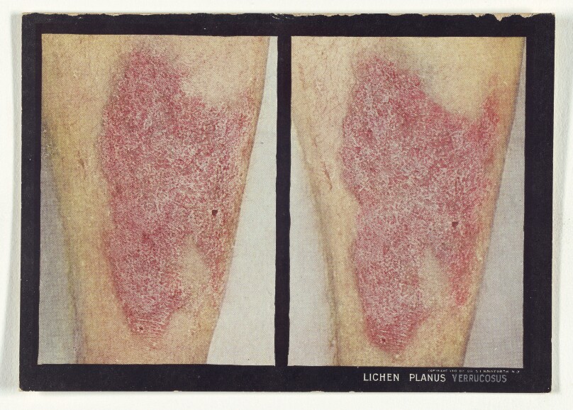 Lichen Planus Verrucosus