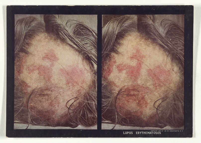 Lupus Erythematosus