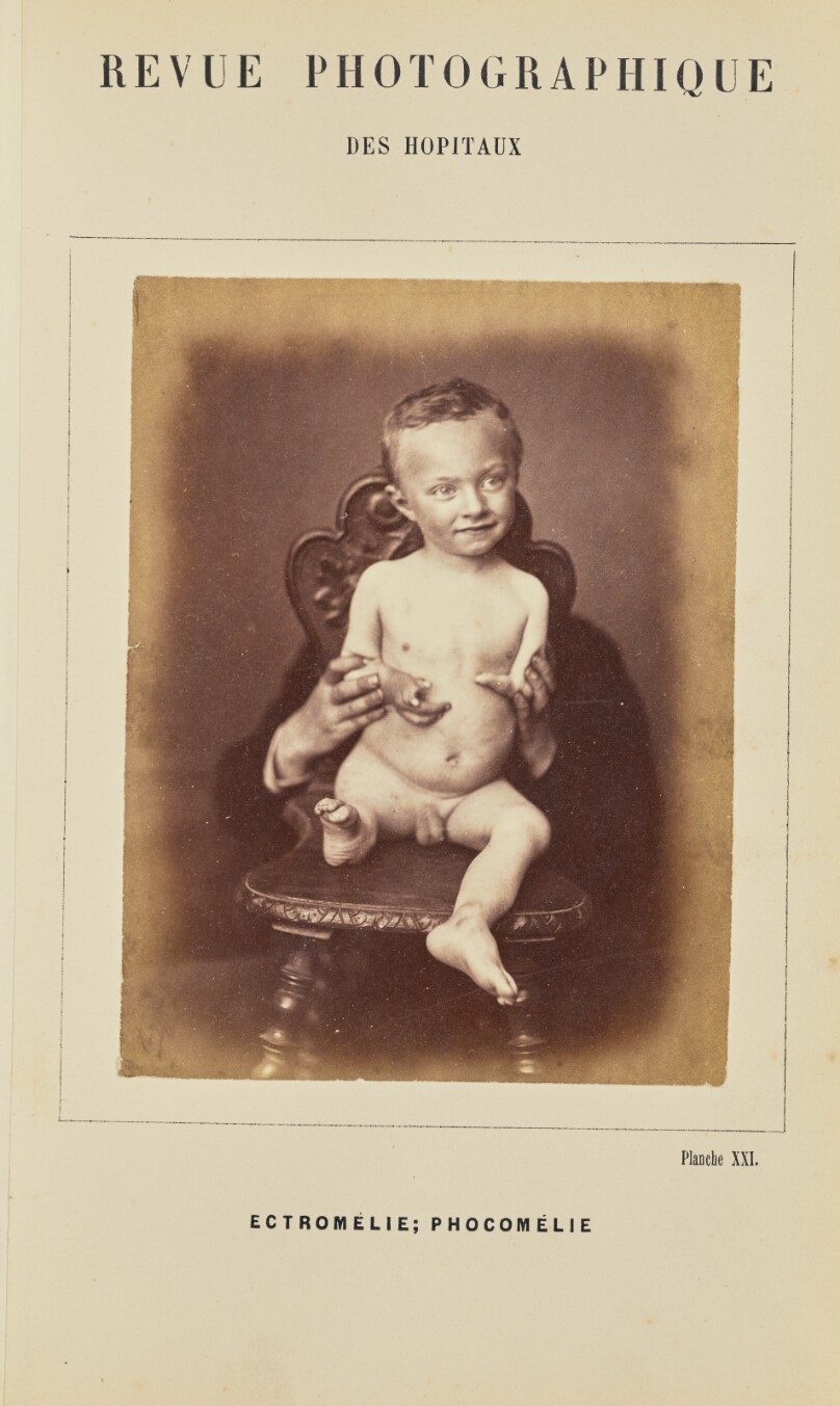 Ectromélie; Phocomélie