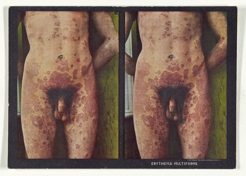 Erythema Multiforme