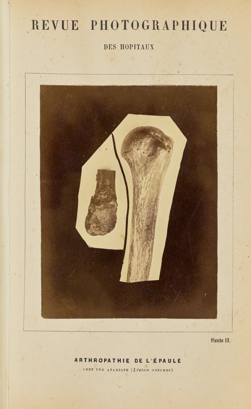 Arthropathie de l'épaule, chez une ataxique (lésions osseuse)