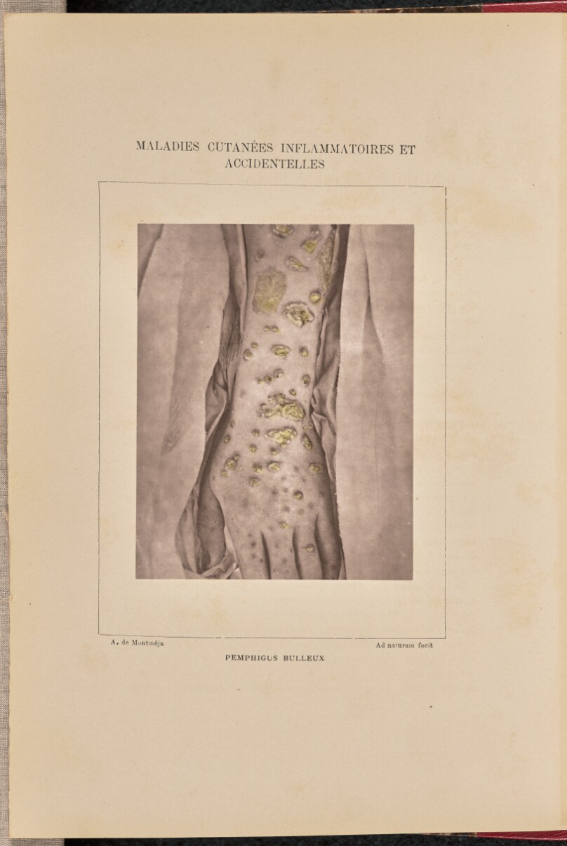 Pemphigus bulleux